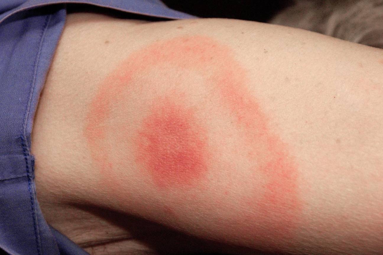 The bullseye rash that can signify Lyme Disease